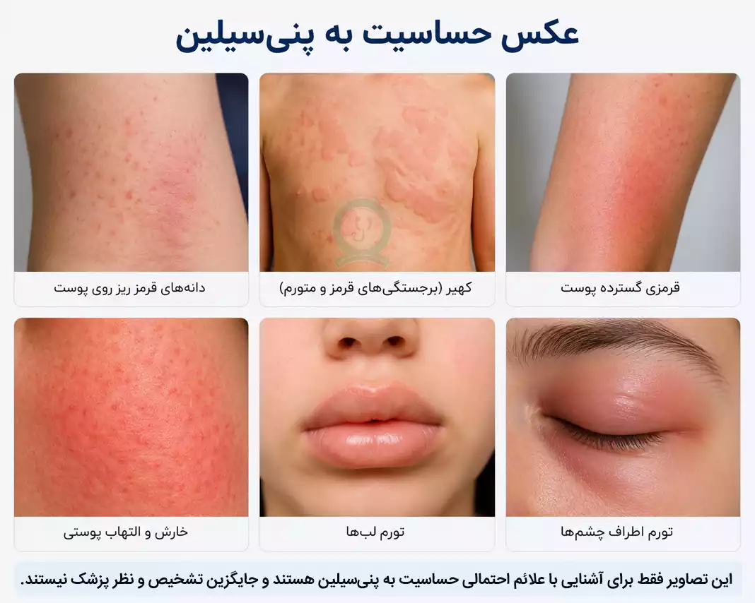 عکس حساسیت به پنی سیلین