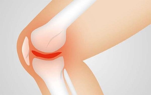 علت زانو درد هنگام نشستن و برخاستن